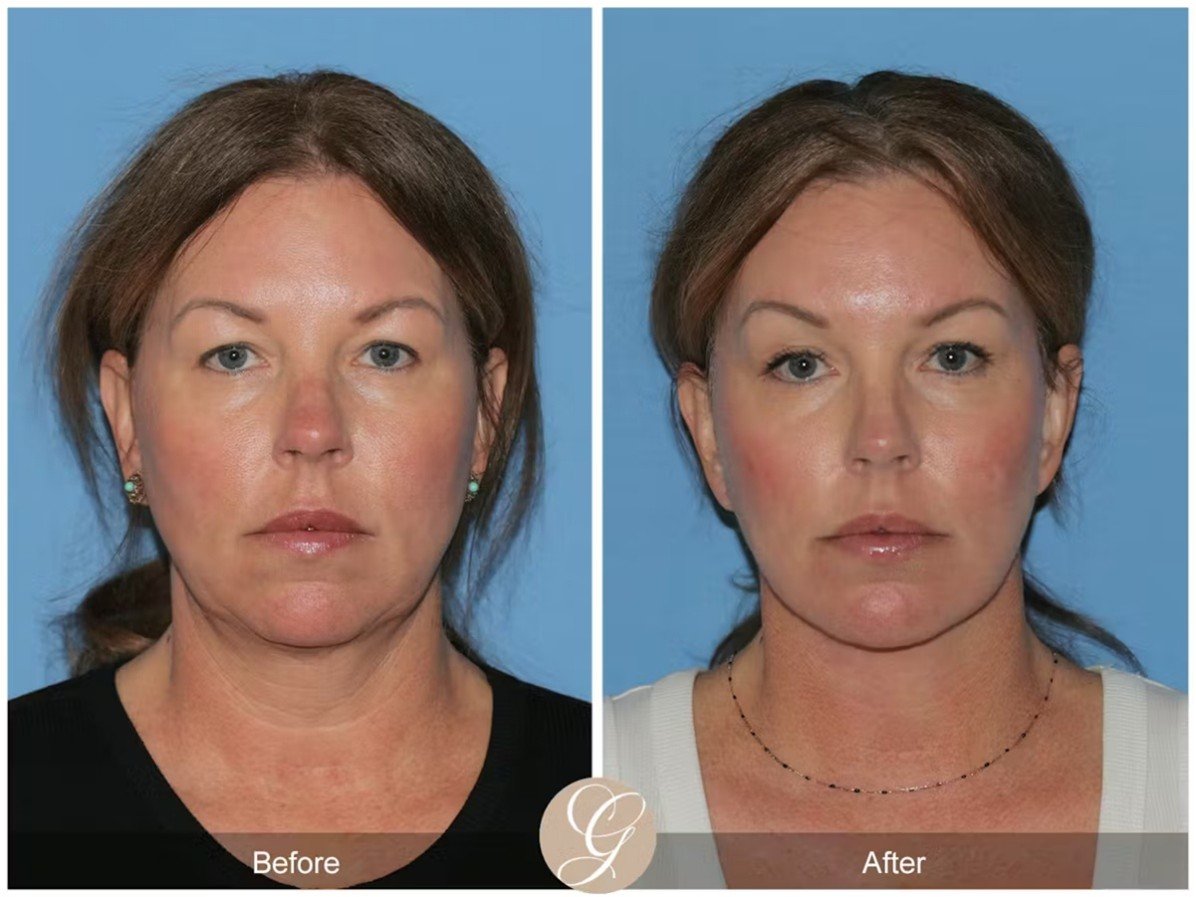 Understanding the Preservation Lift Vs. Mini Deep Plane Facelift Preservation Facelift