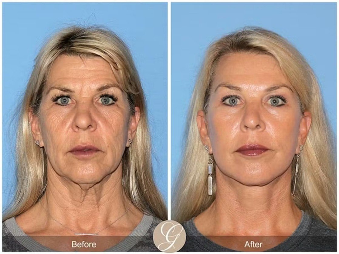 Understanding the Preservation Lift Vs. Mini Deep Plane Facelift Preservation Facelift Example